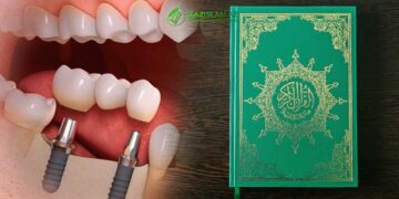 Дозволено ставить зубные импланты?