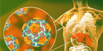 Елімізде А гепатитін жұқтыру 7 есеге артқан